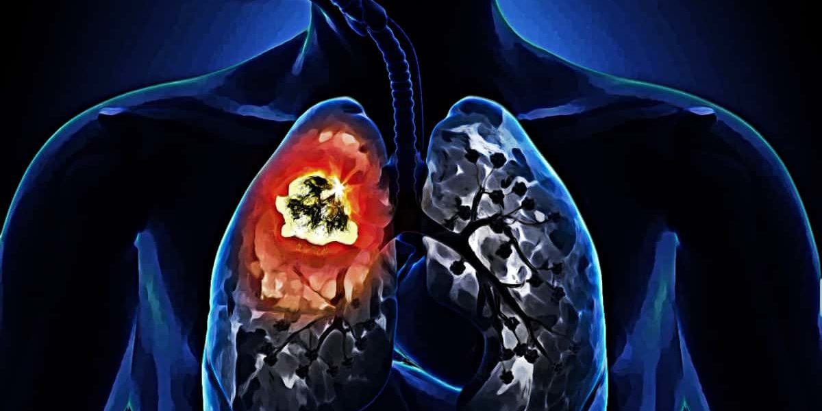 Inail Registro Mesoteliomi