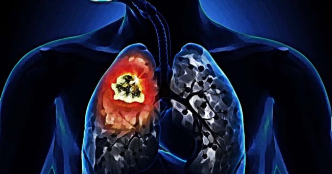 Inail Registro Mesoteliomi