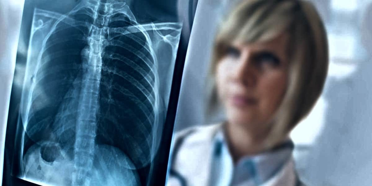 Benefici Assistenziali Mesotelioma non professionale