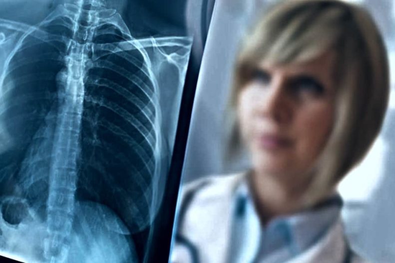 Benefici Assistenziali Mesotelioma non professionale